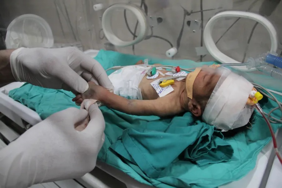 Beba, hospitalizirana zbog pothranjenosti i dehidracije, leži u inkubatoru u bolnici Kamal Adwan